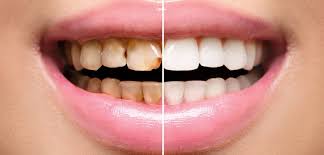 images Dental Exams and Cleaning | Flourish Dental