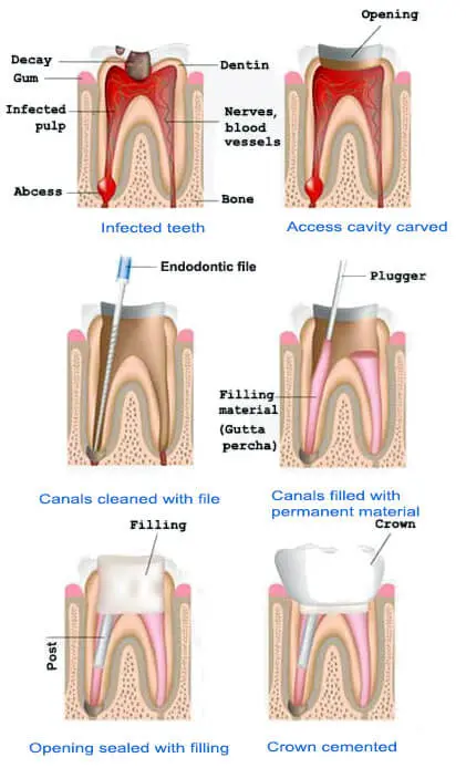 Root Canal Therapy