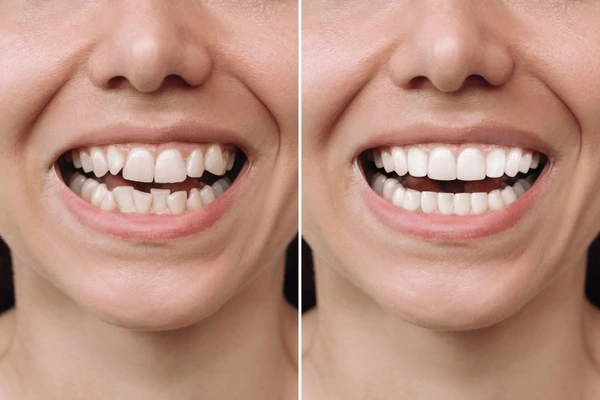 Braces | Flourish Dental